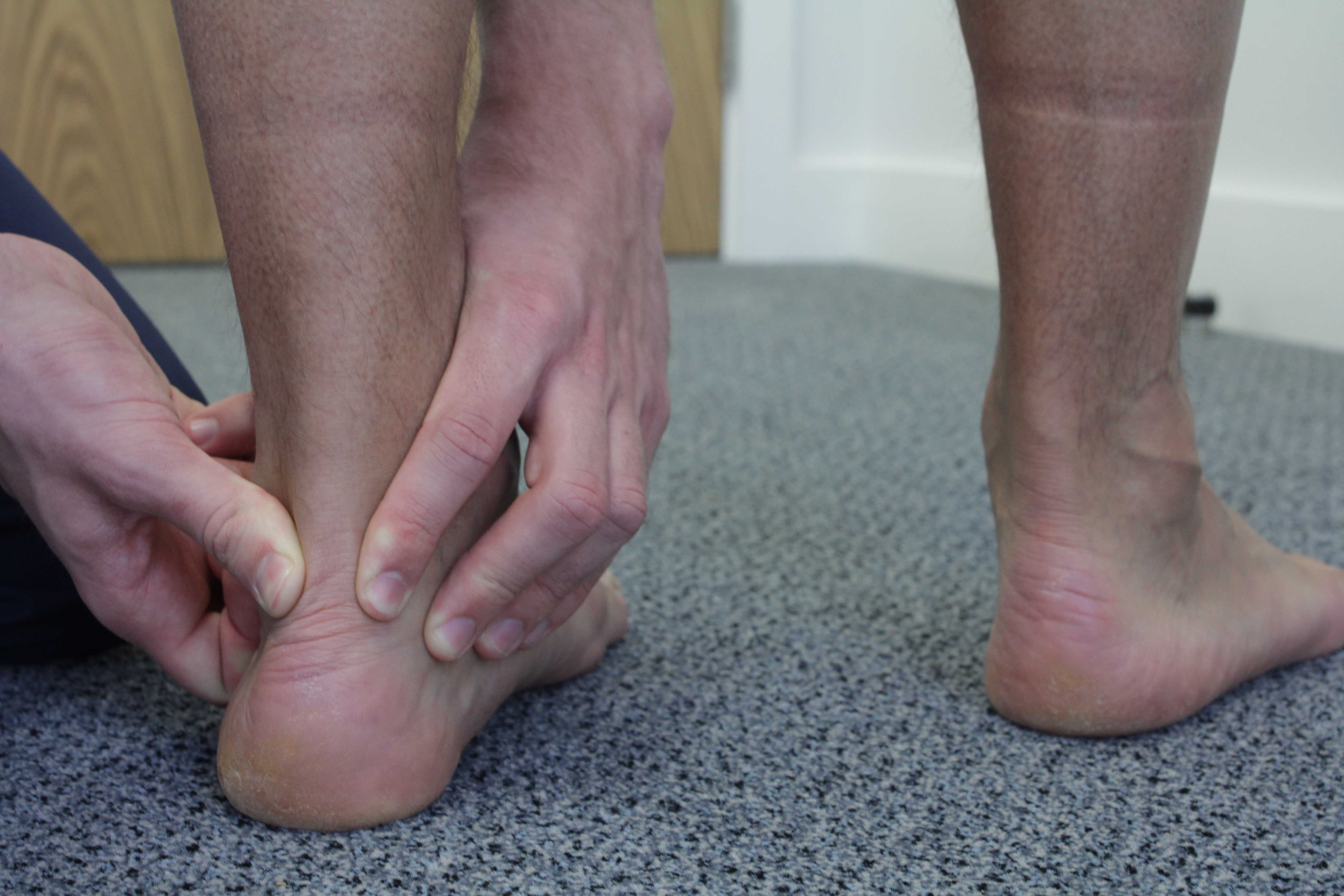 Ankle achilles tendon rupture is common with preexisting tendonitis.