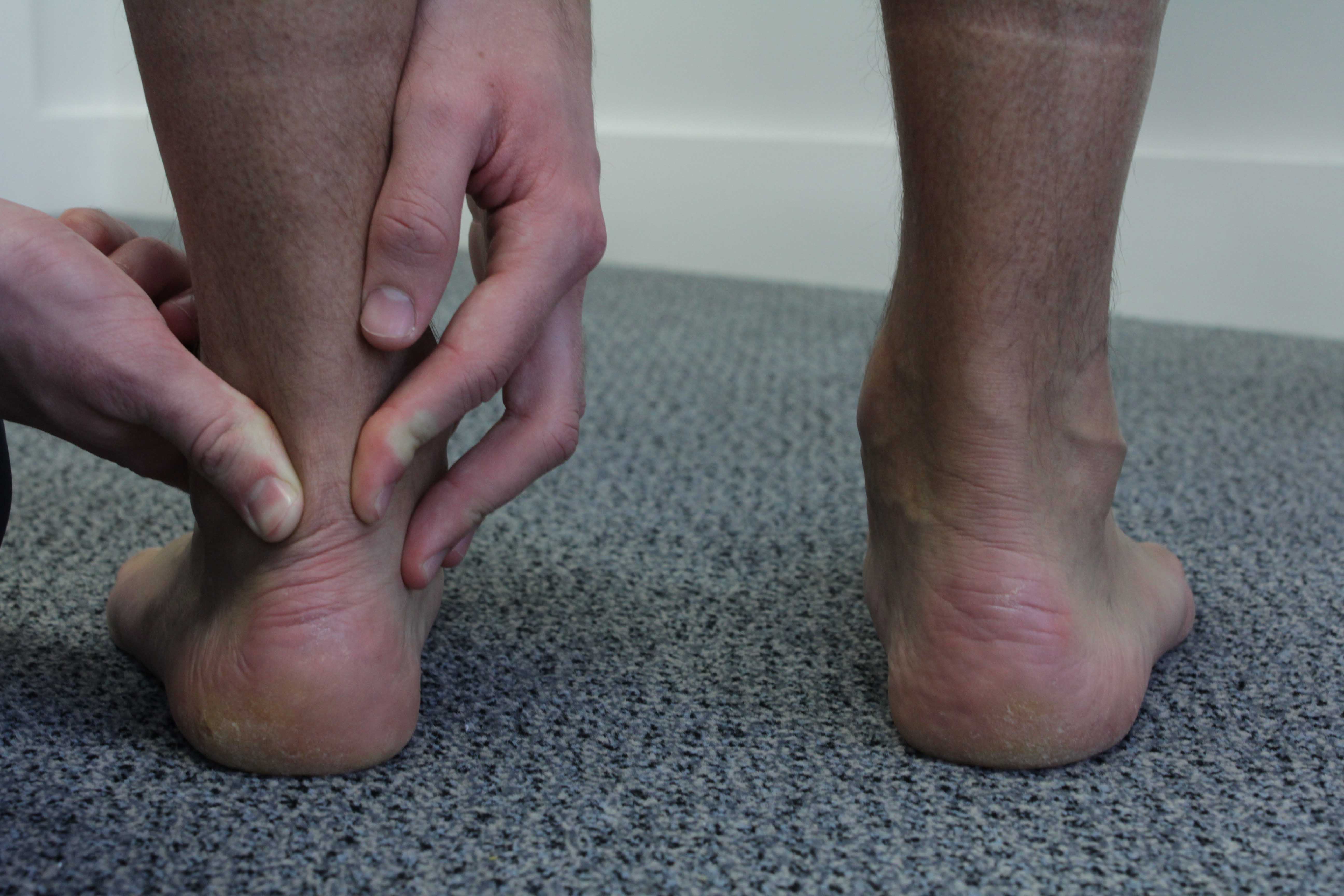 Ankle tendinopathy can be uncomfortable, our physiotherapists can provide advice on how to best manage this,